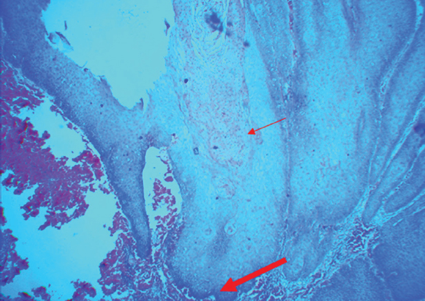 Photomicrograph of the incisional biopsy showing stratified squamous epithelium with papillary masses, keratin plugging (thin red arrow) and blunt and broad rete pegs with underlying chronic inflammatory cells (thick red arrow) in the connective tissue (H and E, ×4).